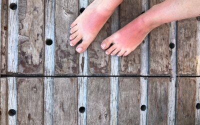 10 Ways to Soothe Sunburned Toes with Home Remedies