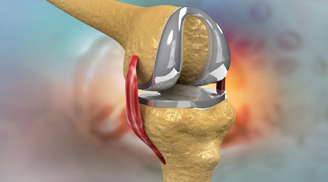 partial and total knee replacement