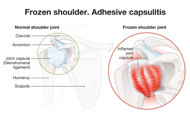 This graphic shows different components of the shoulder