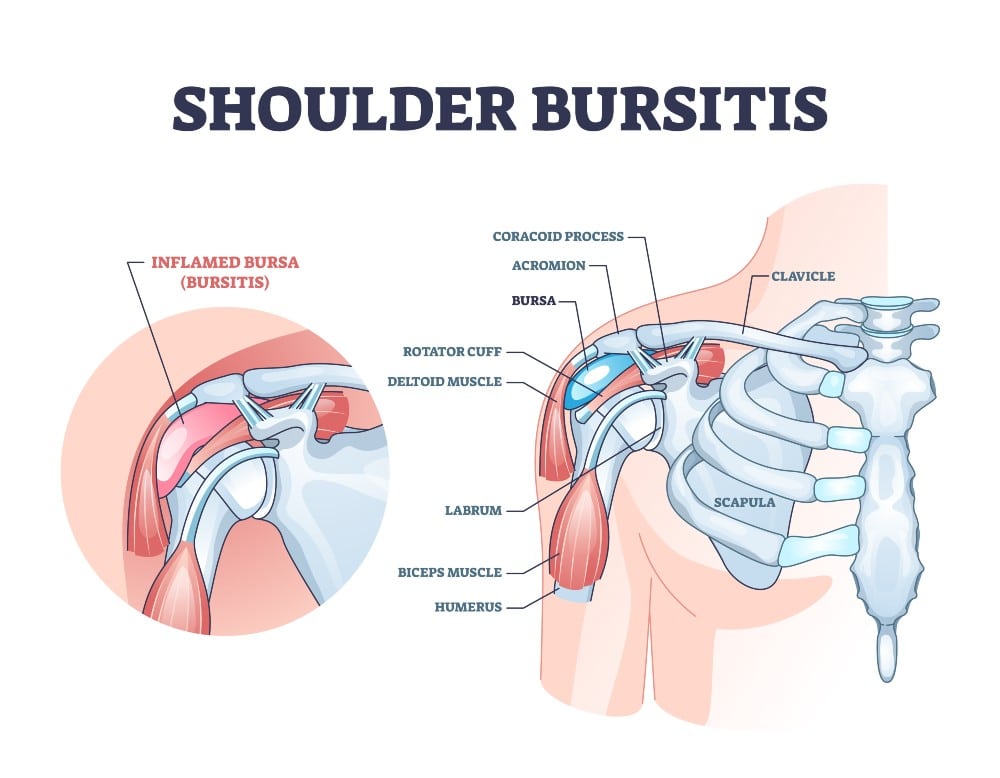 Shoulder bursitis explained