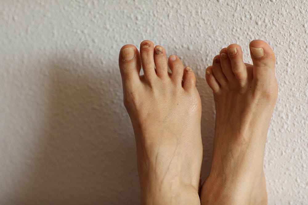 Black toenails on bare feet